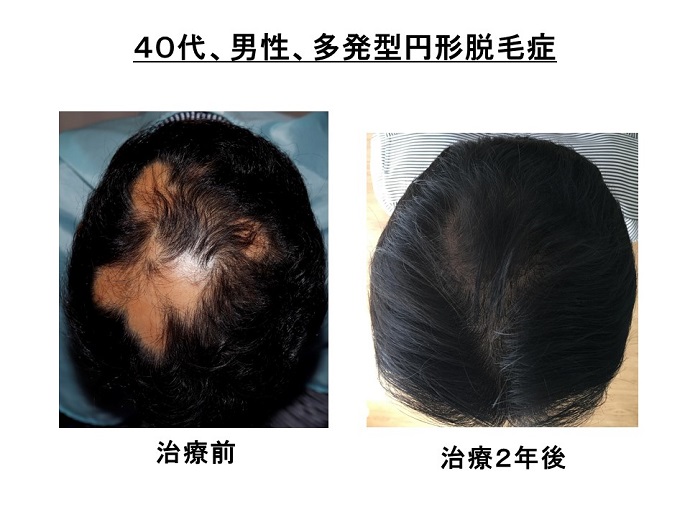 円形脱毛症　病院